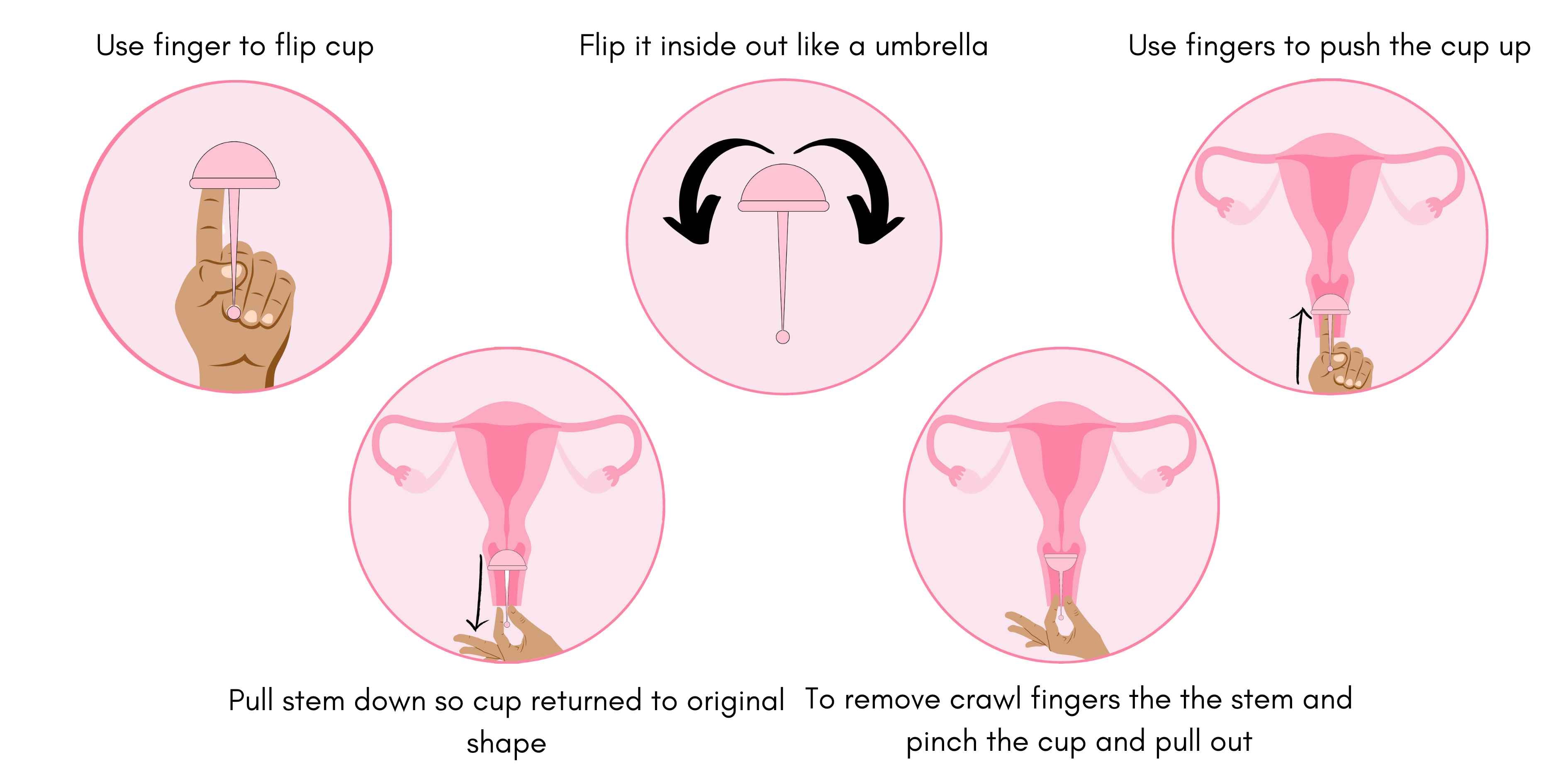 Cervix Sperm Cup used after sex or insemination to hold sperm close to the cervix, often referred to as a conception cup